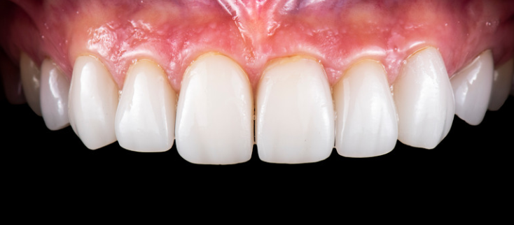 How Strong Are Ceramic Crowns?